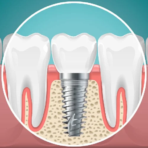 Impianti Dentali Premium