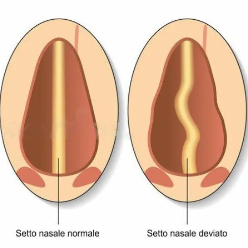 Rinosettoplastica